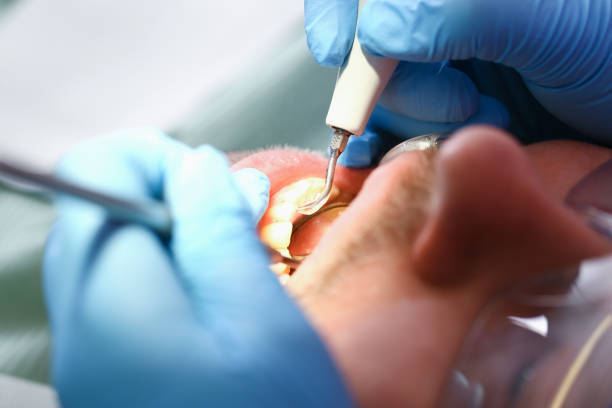 Best Knocked-Out Tooth Emergency  in Bellefontaine, OH